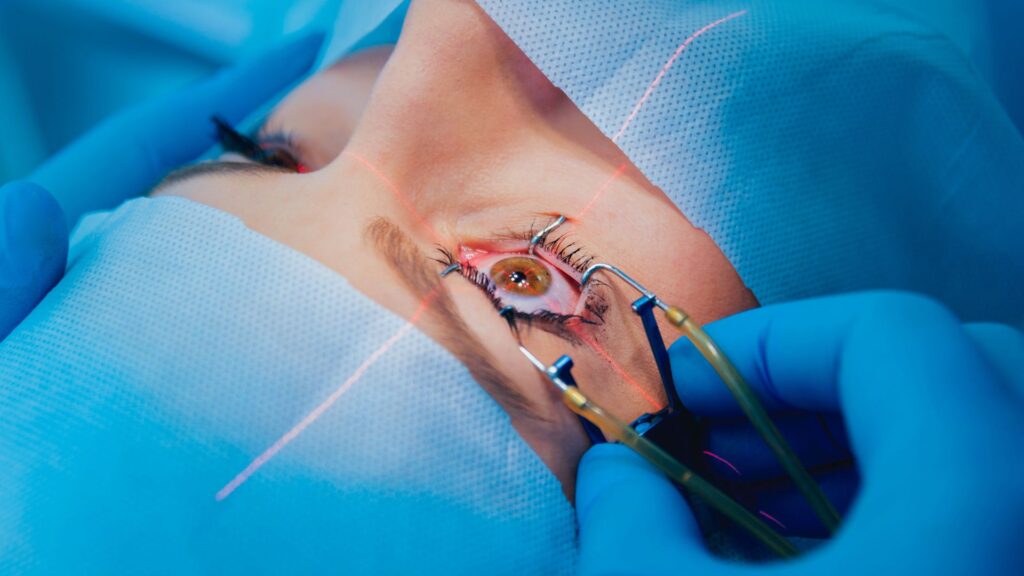 Cataract Surgery