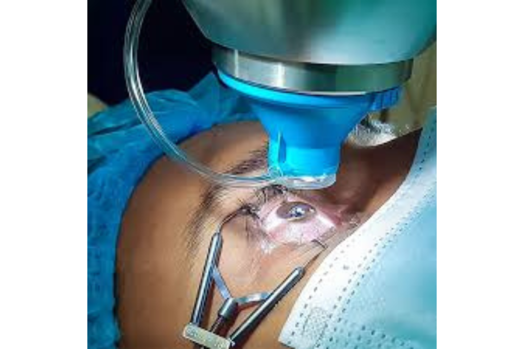 LASIK Surgery Cost in Ambikapur